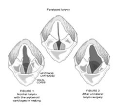 diagram of laryngeal paralysis phases